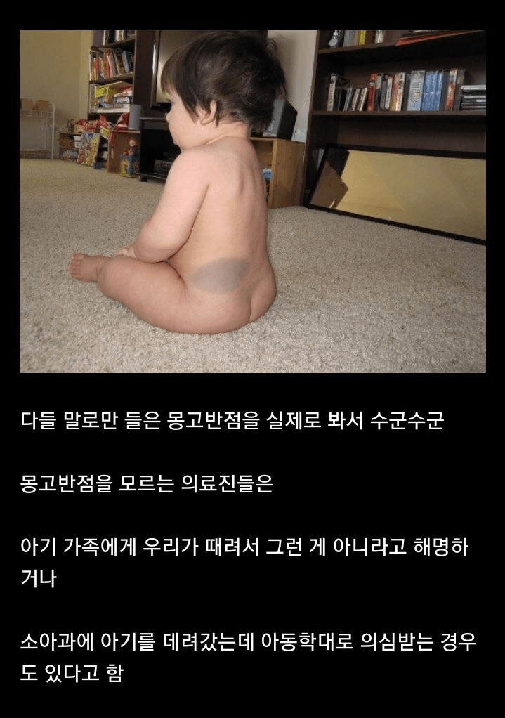 [이슈/유머] 몽고반점 모르는 미국 의사들